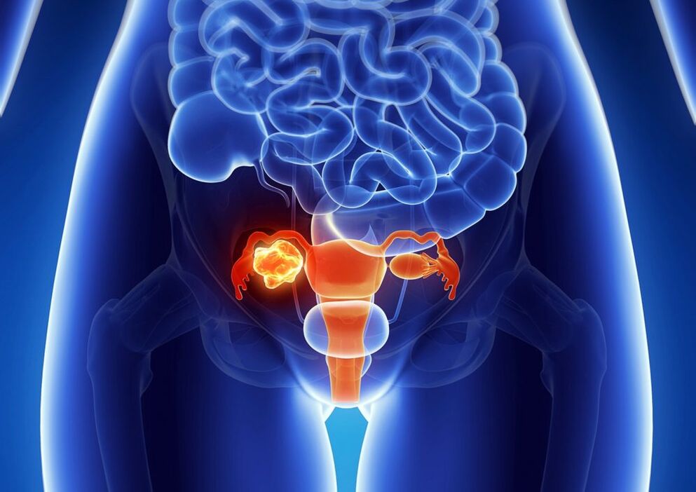 Pathologie ovaire des femmes sous l'influence de l'alcool